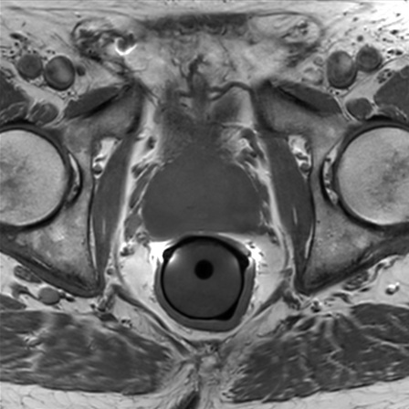 Prostate Imaging With Ds Endo Ds Torso Coil Philips Mr Body Map