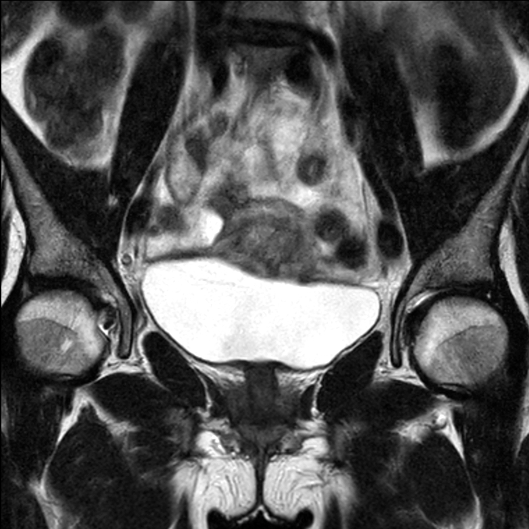 Mri Simulation For Cervix Treatment Variable Bladder Filling State