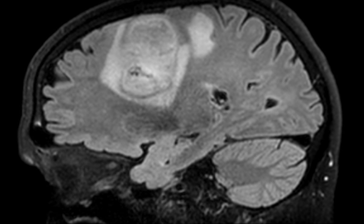 Brain With Glioblastoma Incl D Apt Philips Mr Body Map