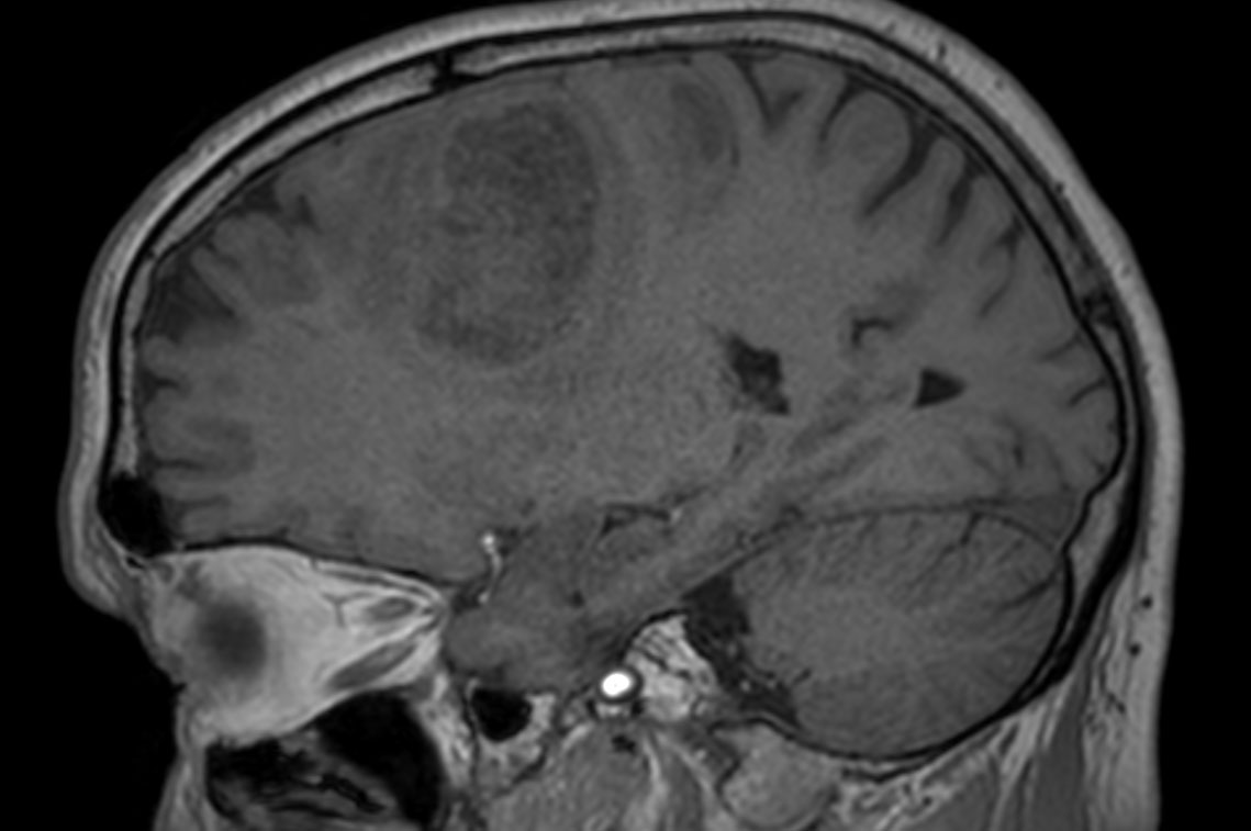 Brain With Glioblastoma Incl D Apt Philips Mr Body Map