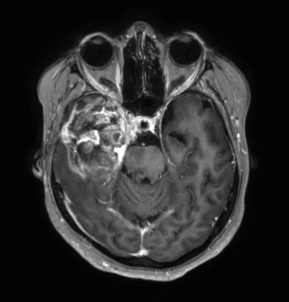 Brain Astrocytoma Post Radiotherapy Incl 3D APT Philips MR Body Map