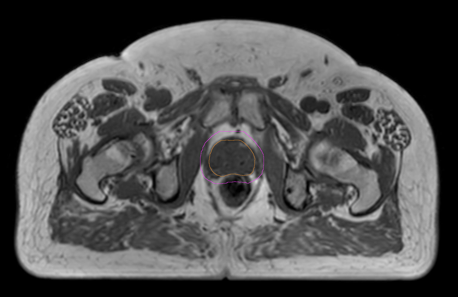 MR Only Simulation Prostate Philips MR Body Map