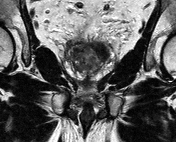 Prostate With The Ds Torso Coil At T Philips Mr Body Map