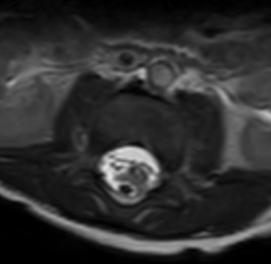 Pediatric Total Spine With Spina Bifida Philips Mr Body Map