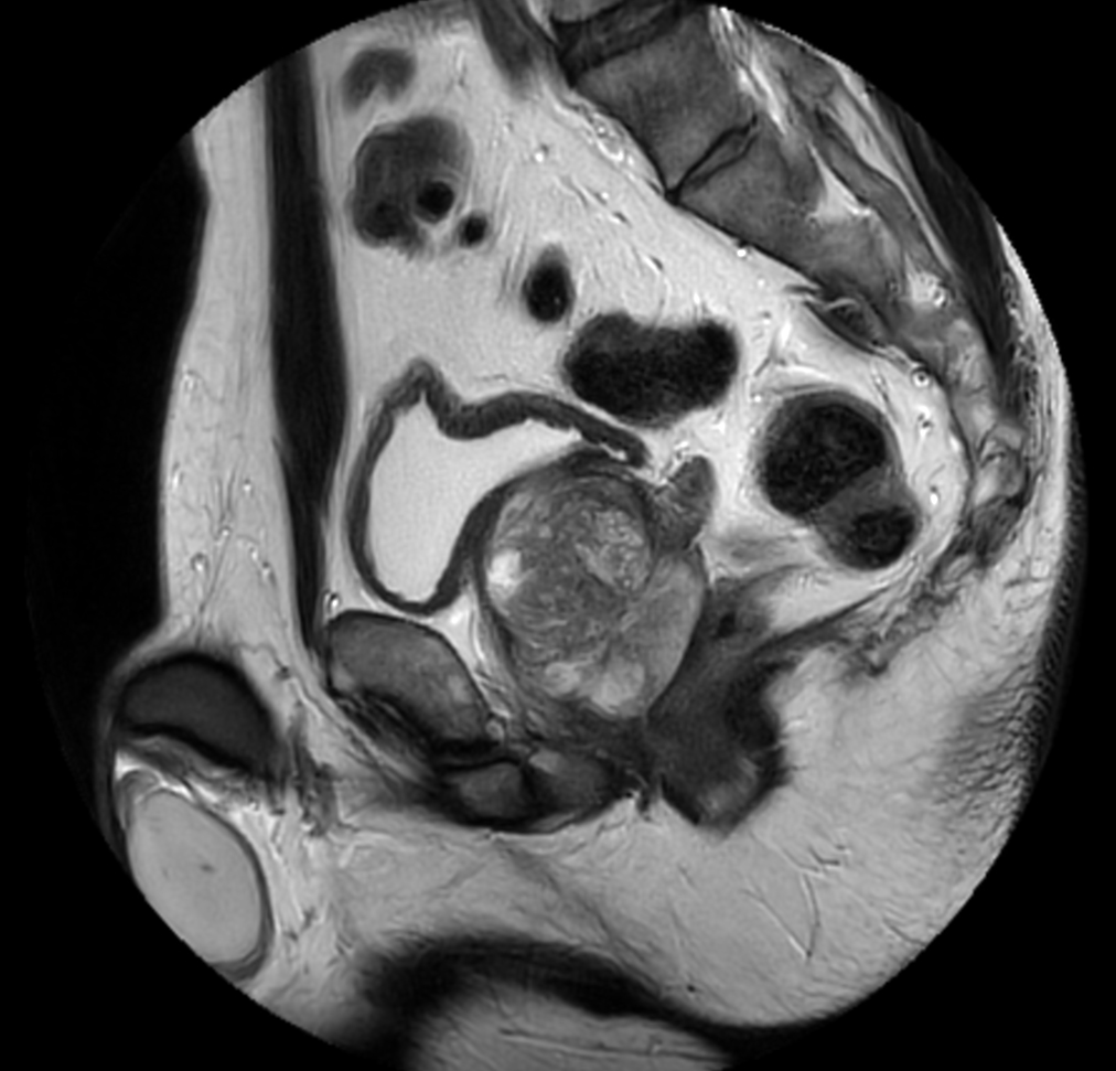 Compressed SENSE Prostate Imaging Philips MR Body Map