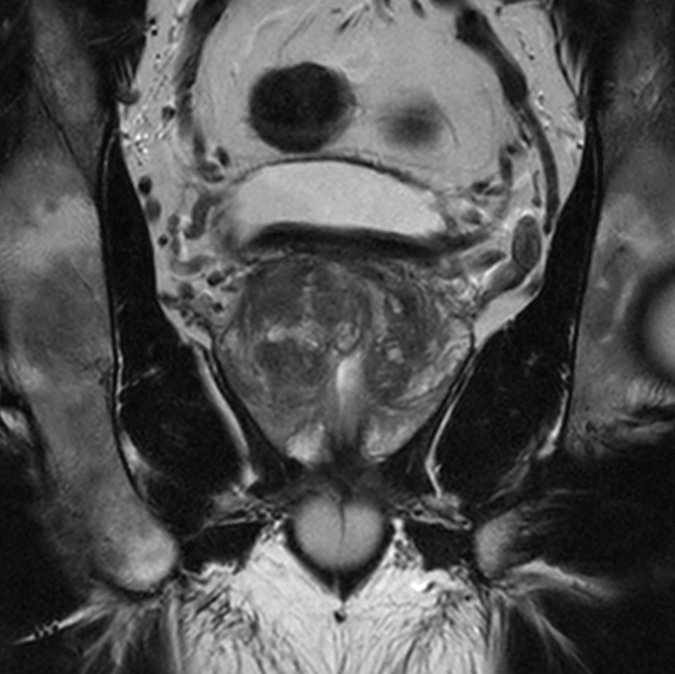 Compressed Sense Prostate Imaging Philips Mr Body Map