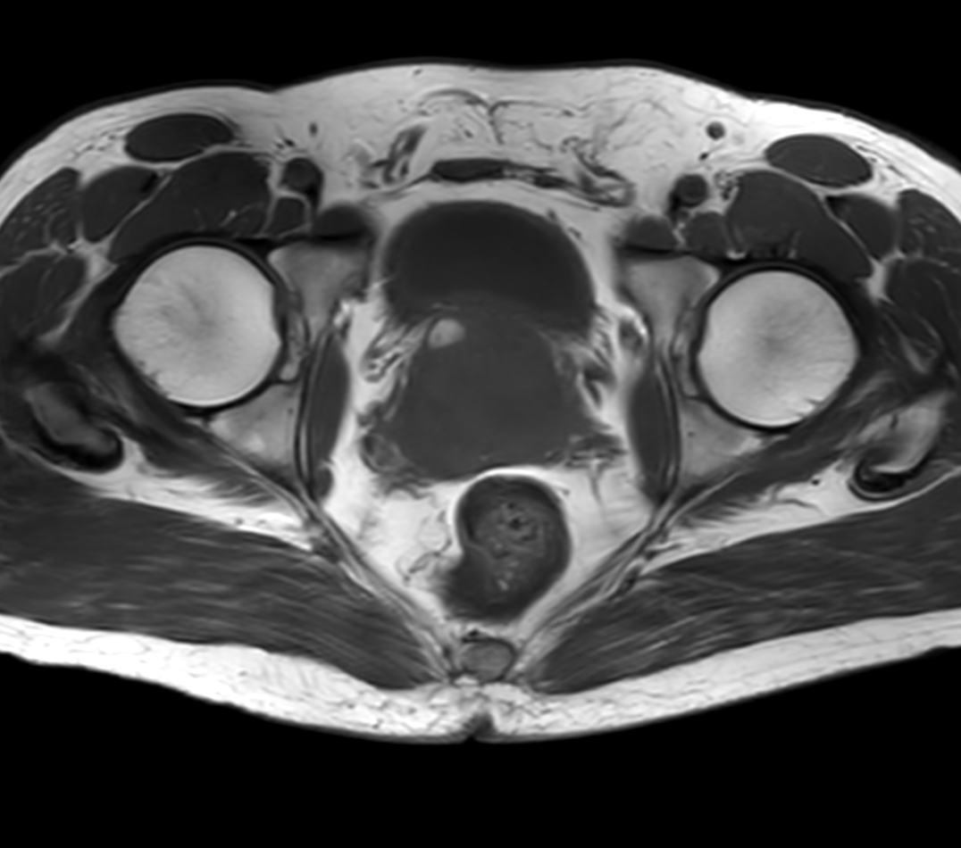 Compressed Sense Prostate Imaging Philips Mr Body Map