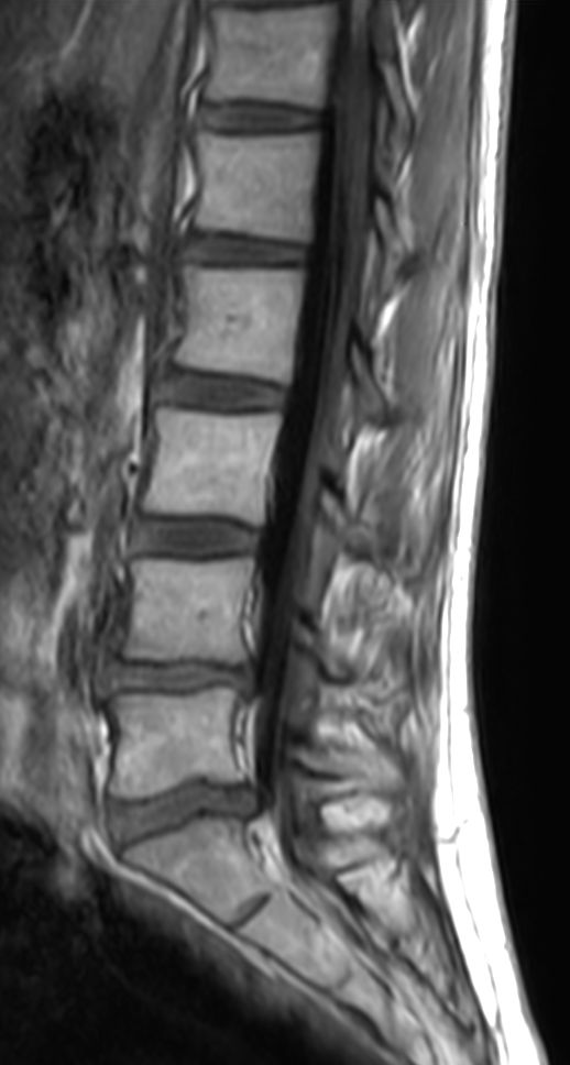 Lumbar Spine In Under Minutes Total Exam Time Philips MR Body Map