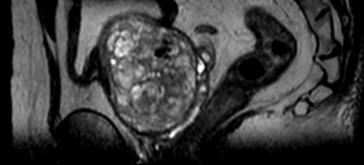 Multi Phase Contrast Enhanced Prostate Imaging Philips Mr Body Map