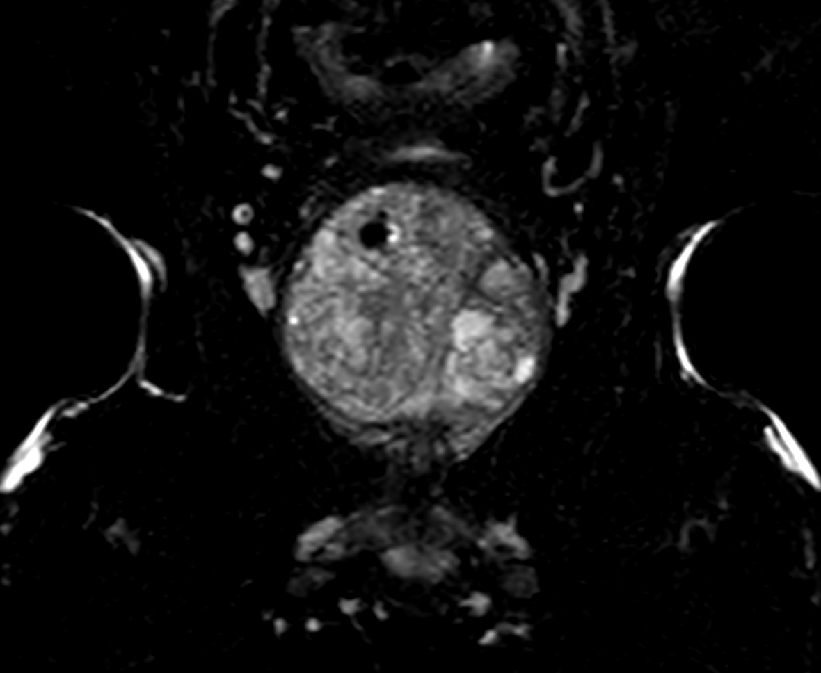 Multi Phase Contrast Enhanced Prostate Imaging Philips MR Body Map