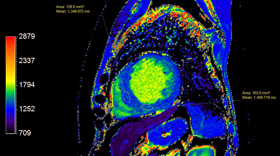 Myocardial Infarction With T1 T2 Mapping Philips MR Body Map