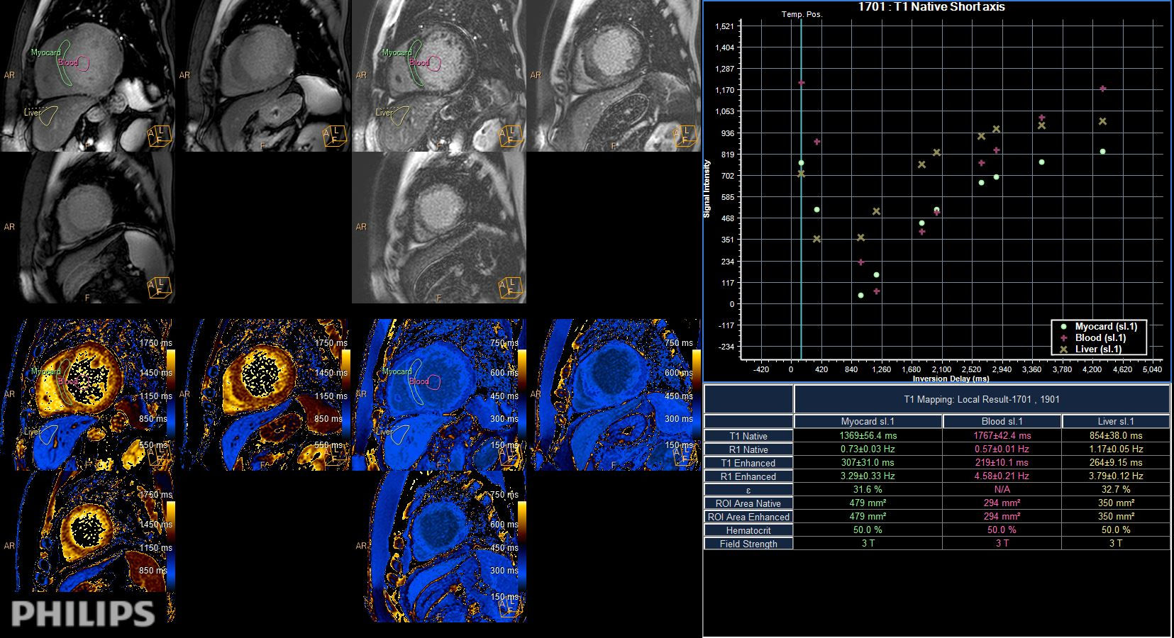 Myocardial Infarction With T T Mapping Philips Mr Body Map