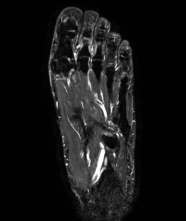 SmartSpeed Forefoot Imaging Philips MR Body Map