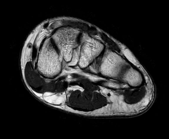 Smartspeed Forefoot Imaging Philips Mr Body Map