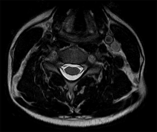 Comprehensive Cervical Spine Imaging At T Philips MR Body Map